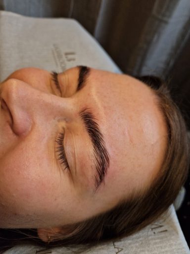 Browlifting